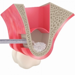 Синус-ліфтинг