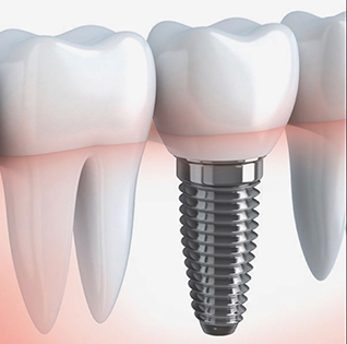 Імплантація