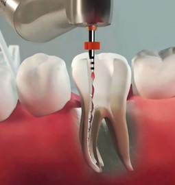 Ендодонтія